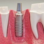 Dental Implants Austin