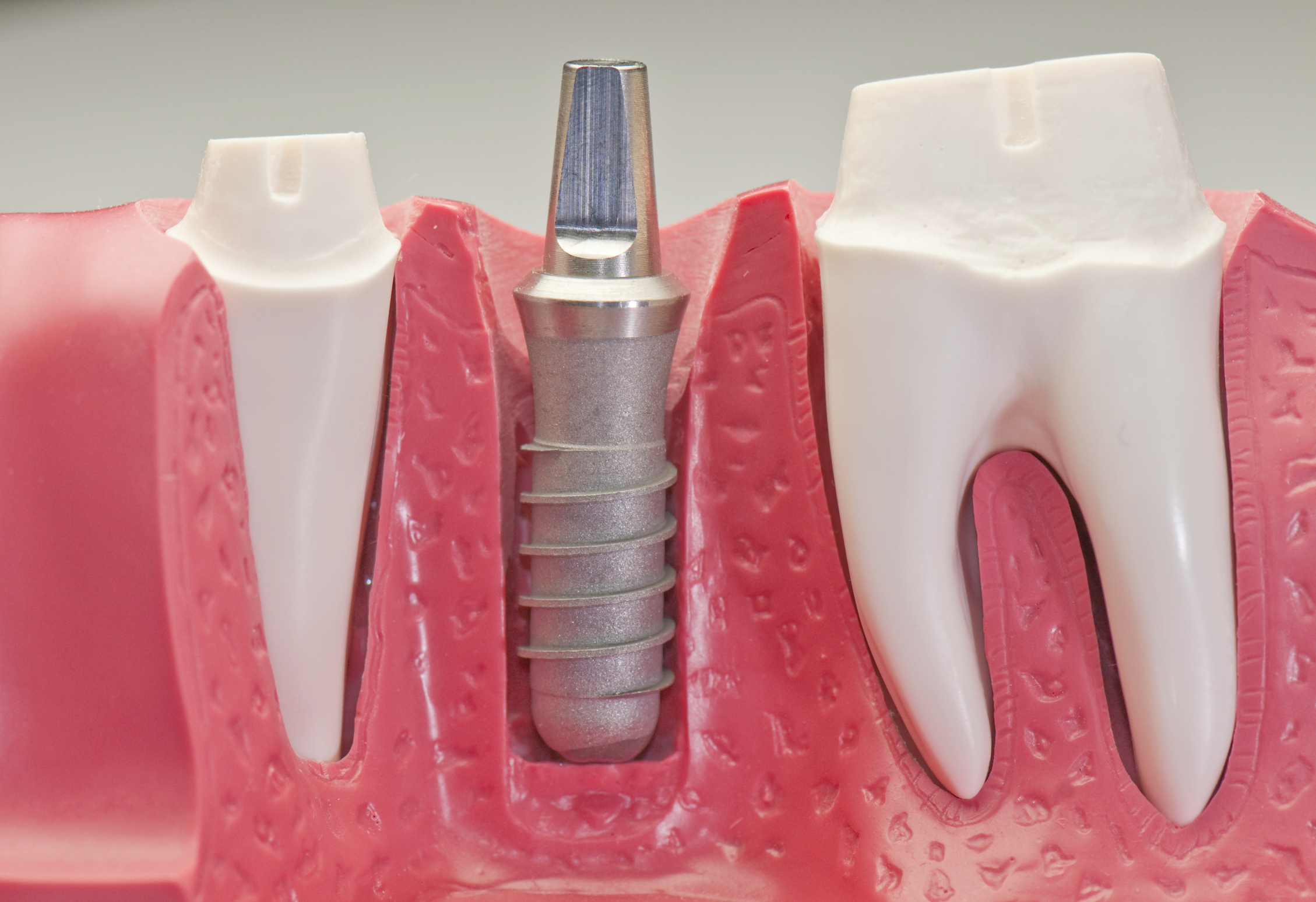Dental Implants Austin