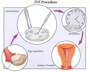 Aspects To Consider When Preparing For IVF Clinic Treatments