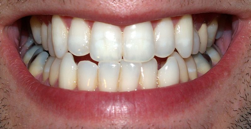 Healthy teeth