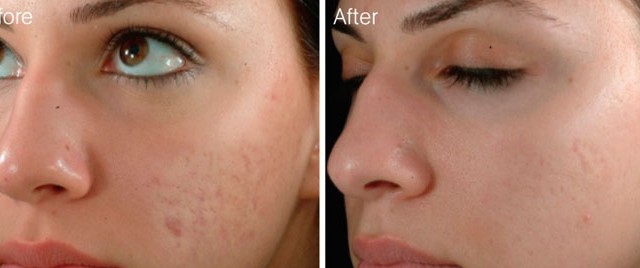 Can Botox Help Remove Acne Scars?