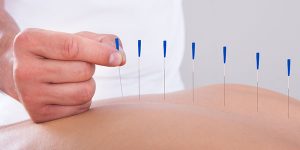 Acupuncture: The Boon For The Medical Industry