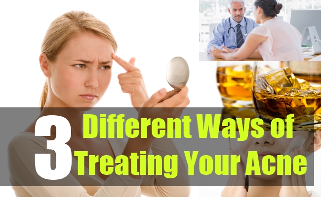 3-Different-Ways-of-Treating-Your-Acne