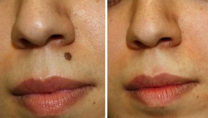 Mole Removal Is An Easy Solution If You Know The Removal Product Properly