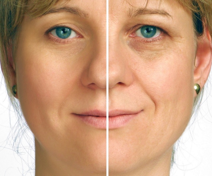 Recovery Stages After A Facelift Surgery You Should Be Aware Of