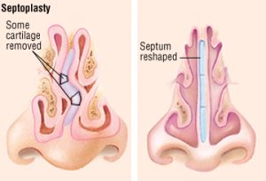 6 Signs You May Have a Deviated Septum by rhinoplastysydney.com.au
