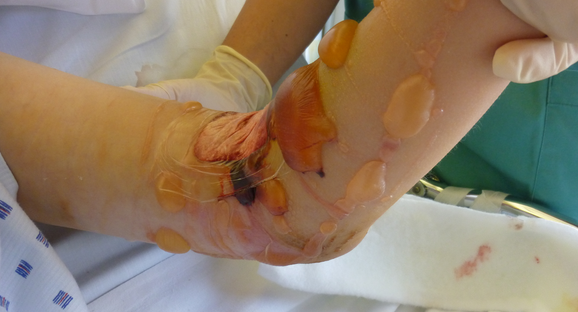 How To Minimize The Development Of Edema Around The Stump