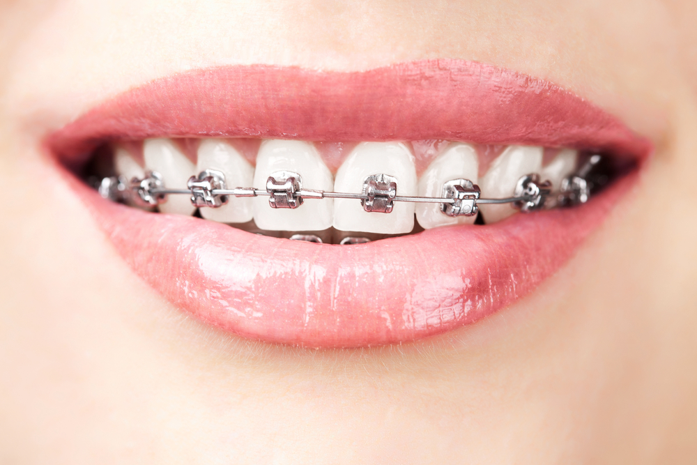The Final Appointment: All About Getting Your Braces Off