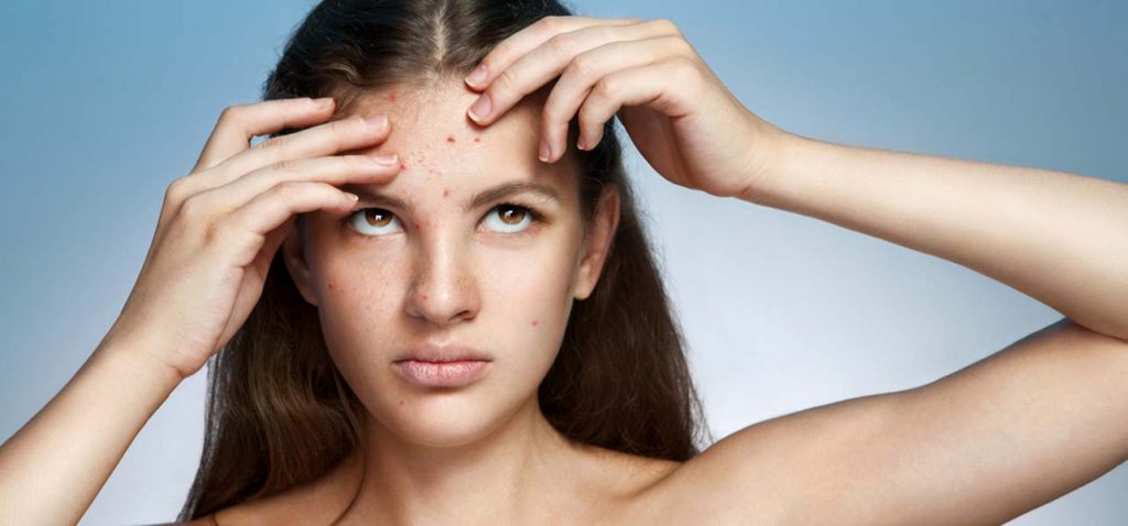 pimples-causes-and-solutions