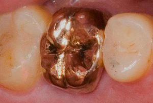 The Wonderful Invention Of The Dental Crown
