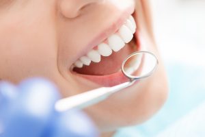 What To Do Before Getting Dental Implants