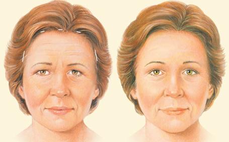 Remove The Signs Of Aging With A Forehead Lift Surgery