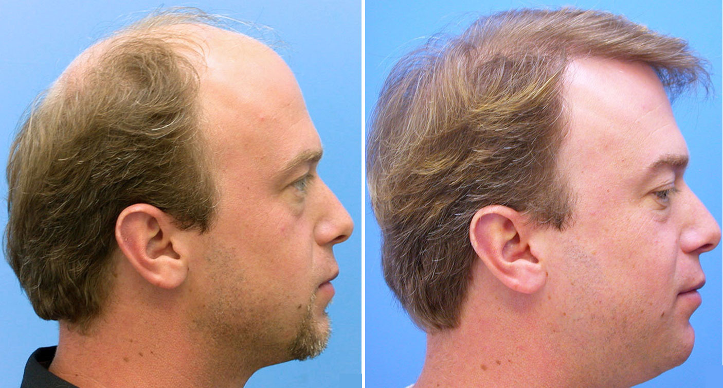 Why Get a Hair Transplant? The Advantages of Hair Transplantation for Men