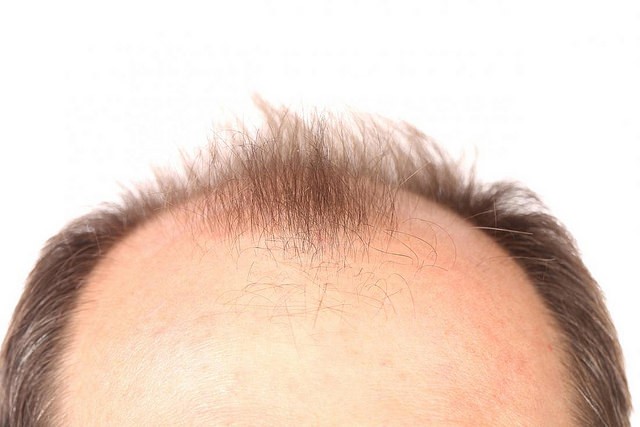 Do Hats Lead To Baldness In Men?